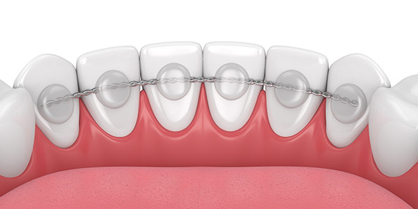 Dental Bonding Specialist Near Me in Oxnard CA