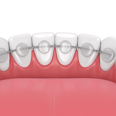 Teeth Bonding Near Me in Oxnard, CA