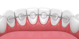 Dental Bonding Specialist Near Me in Oxnard CA