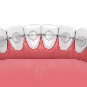 Teeth Bonding Near Me in Oxnard, CA
