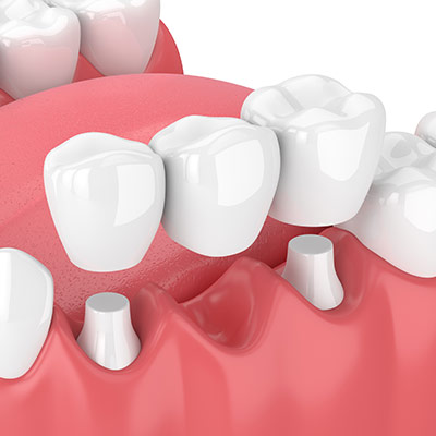 Dental Bridges Near Me in Oxnard, CA