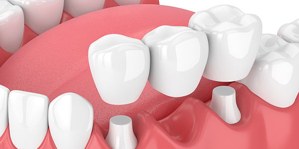 Dental Bridges Specialist Near Me in Oxnard CA