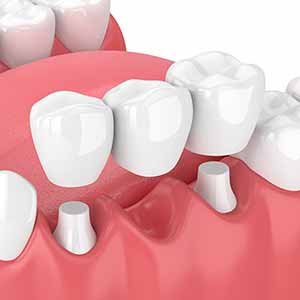 Dental Bridges Near Me in Oxnard, CA