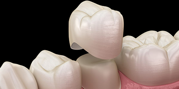 Dental Crowns Specialist Near Me in Oxnard CA