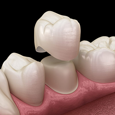 Dental Crowns Near Me in Oxnard, CA