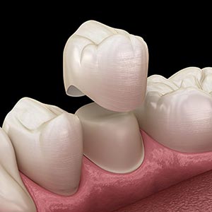 Dental Crowns Near Me in Oxnard, CA