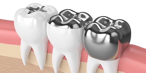 Tooth-Colored Fillings Specialist Near Me in Oxnard CA Tooth-Colored Fillings Specialist Near Me in Oxnard CA