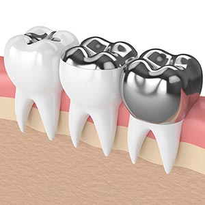 Tooth Colored Fillings Specialist Near Me in Oxnard, CA