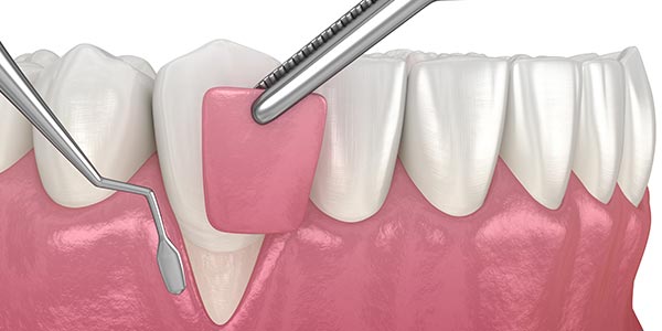 Surgical Gum Cleaning Specialist Near Me in Oxnard CA Surgical Gum Cleaning Specialist Near Me in Oxnard CA