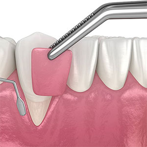 Surgical Gum Cleaning Near Me in Oxnard, CA