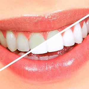 Teeth Whitening Specialist Near Me in Oxnard, CA