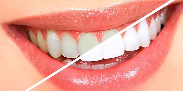 Teeth Whitening Specialist Near Me in Oxnard, CA Teeth Whitening Specialist Near Me in Oxnard, CA