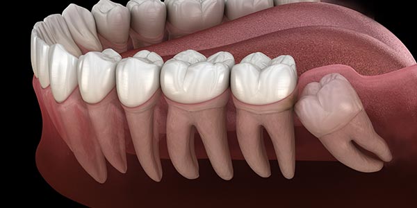 Wisdom Tooth Dentist Near Me in Oxnard CA