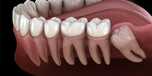 Wisdom Tooth Dentist Near Me in Oxnard CA