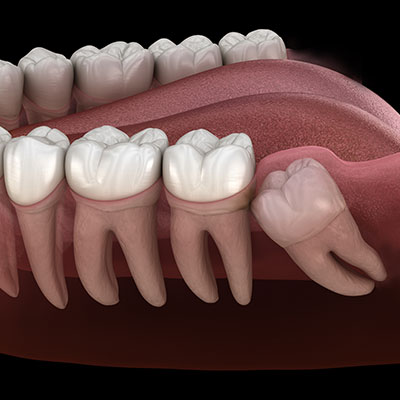 Wisdom Teeth Extractions Specialist Near Me in Oxnard, CA