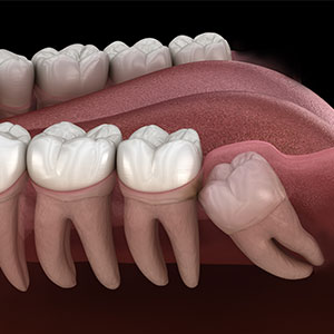 Wisdom Teeth Extractions Specialist Near Me in Oxnard, CA