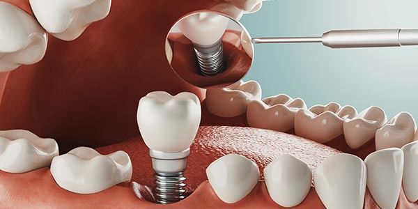 Dental Implants Specialist Near Me in Oxnard CA