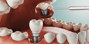 Dental Implants Specialist Near Me in Oxnard CA