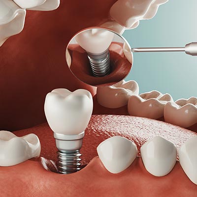 Dental Implants Near Me in Oxnard, CA